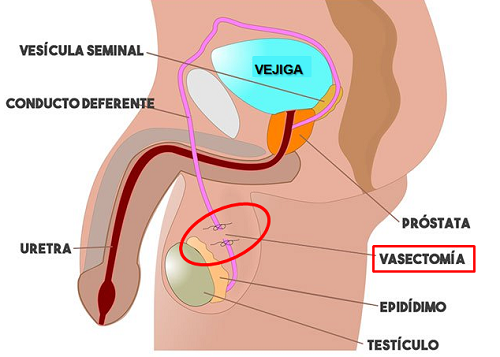 Vasectomia